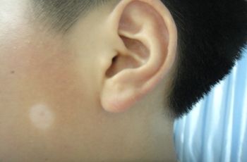 青少年白癜风 青少年白癜风.jpg
