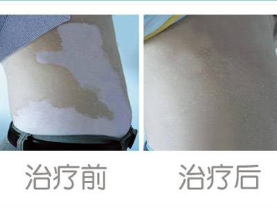 究竟是什么原因导致患上白癜风的 timg.jpg