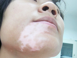 女性白癜风 女性白癜风jpg