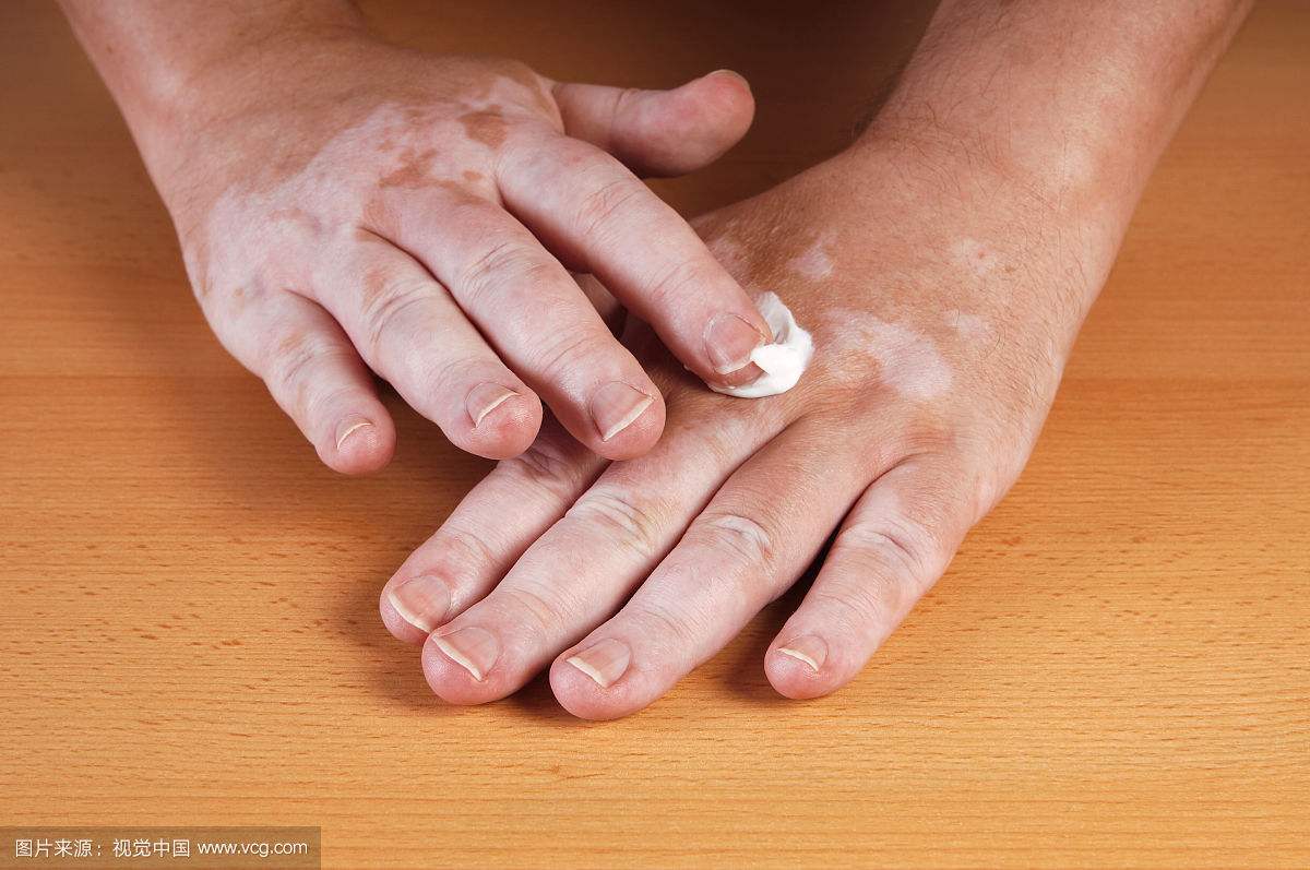 白癜风症状 白癜风症状.jpg