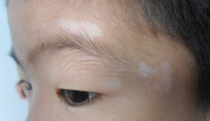 白癜风常识 白癜风常识.jpg